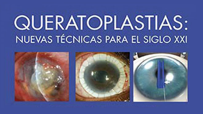 Participación en Queratoplastias: nuevas técnicas para el siglo XXI